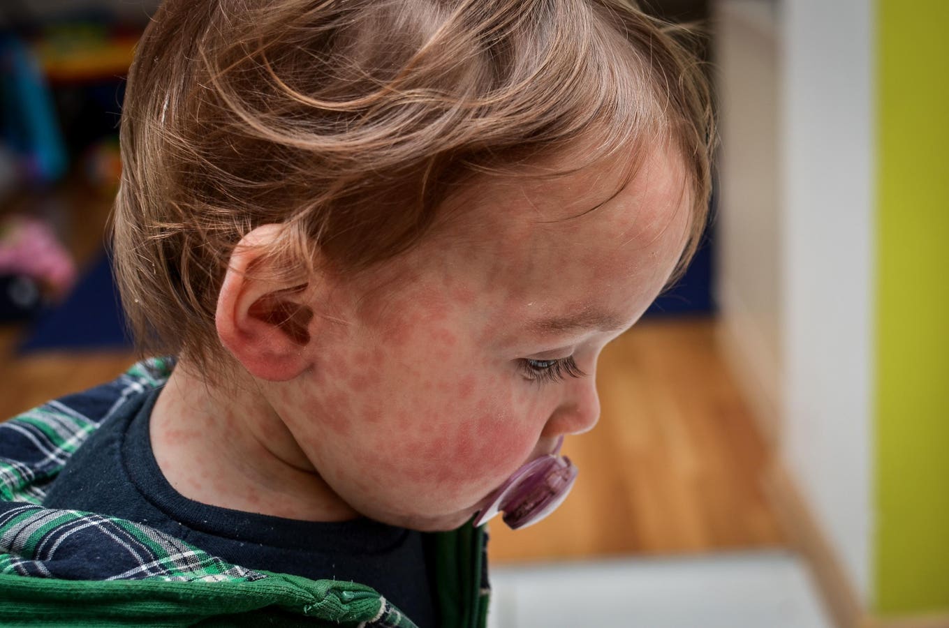 London Measles Outbreak Reported As U.K. Sees Continued Rise in Cases