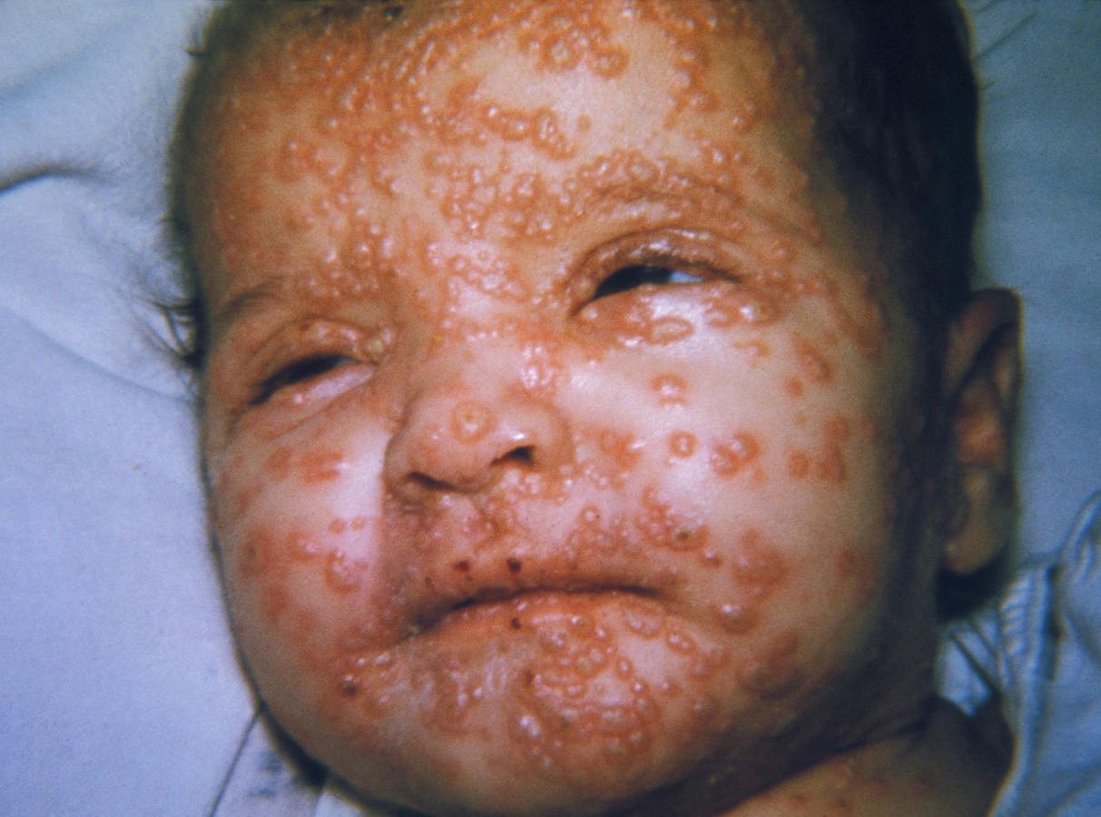 Will Smallpox Virus Get Another Stay Of Execution? Does It Matter?