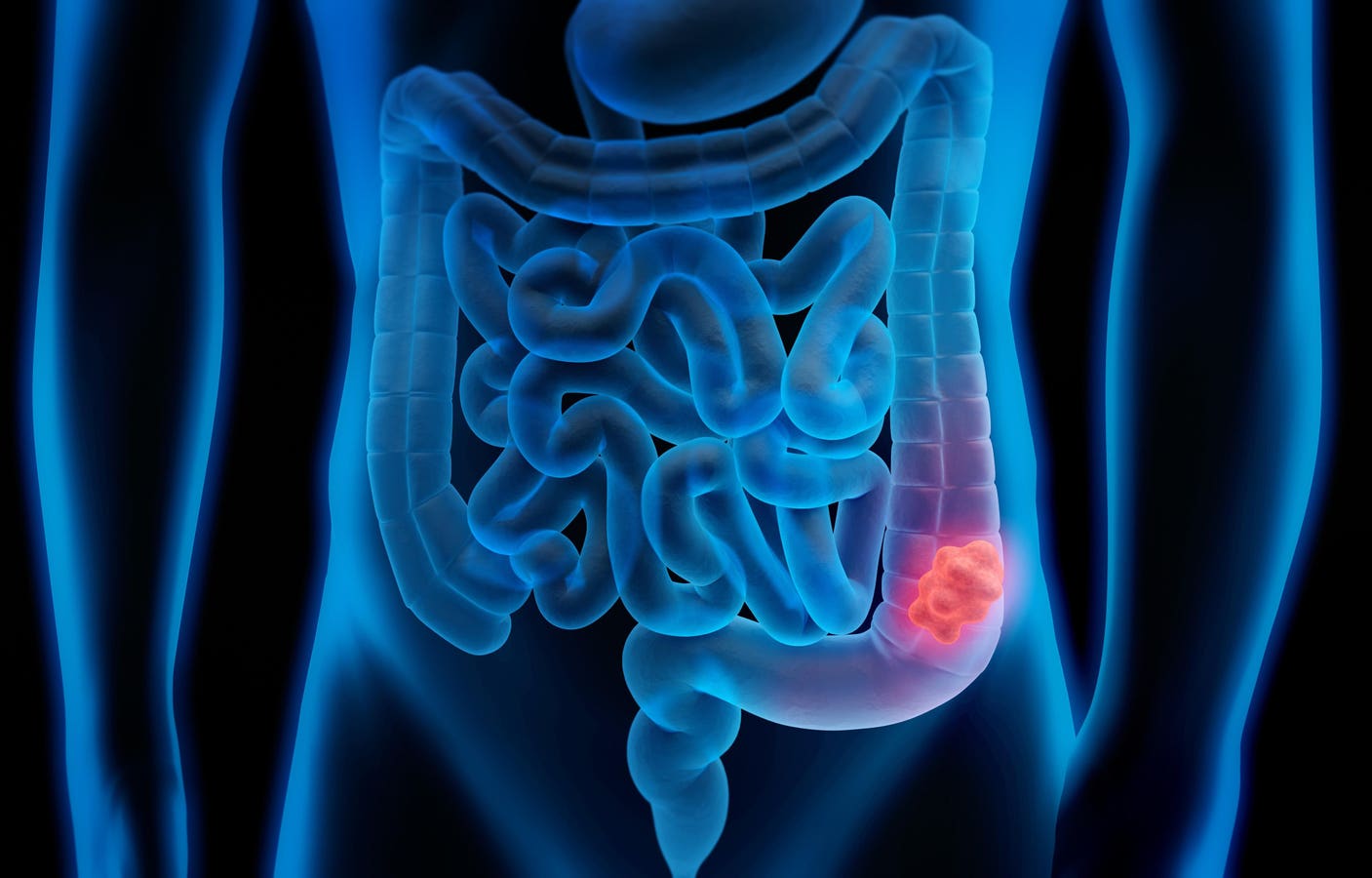 Phase 2 Study Shows Opdivo-Yervoy Highly Effective In Colon Cancer