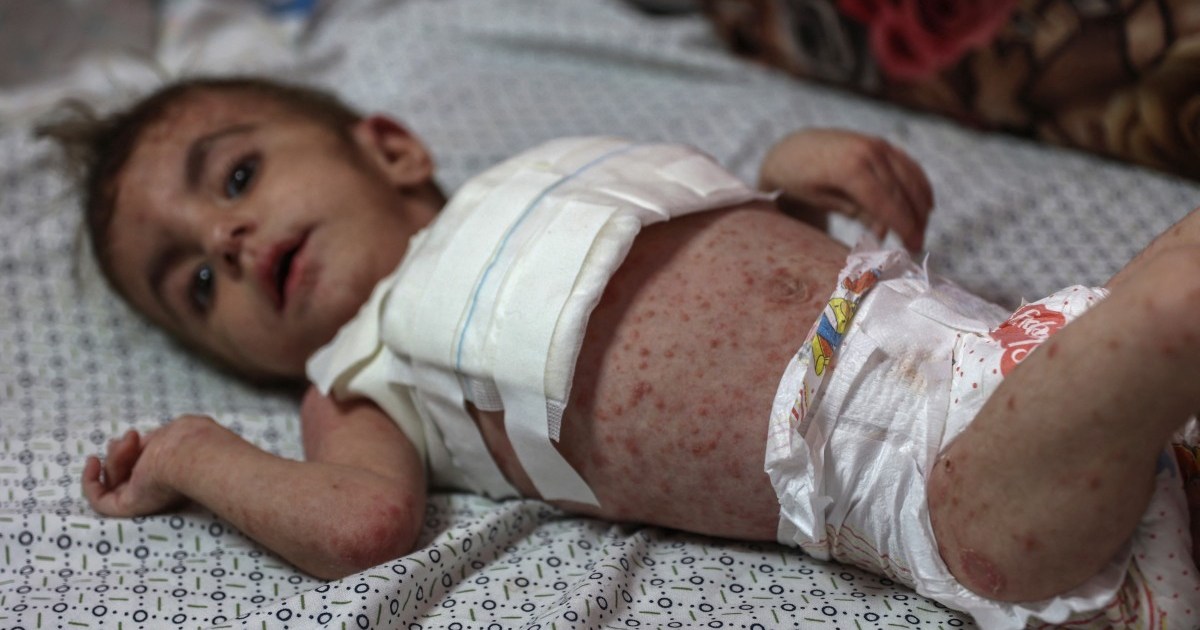 Dangerous skin diseases spreading among children in Gaza | Israel-Palestine conflict News