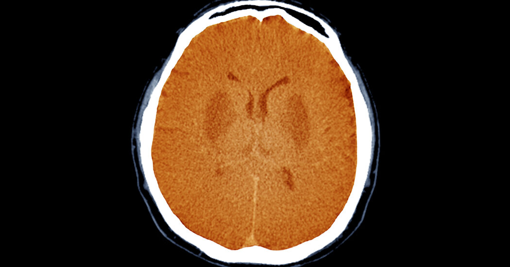 Unresponsive Brain-Damaged Patients May Have Some Awareness