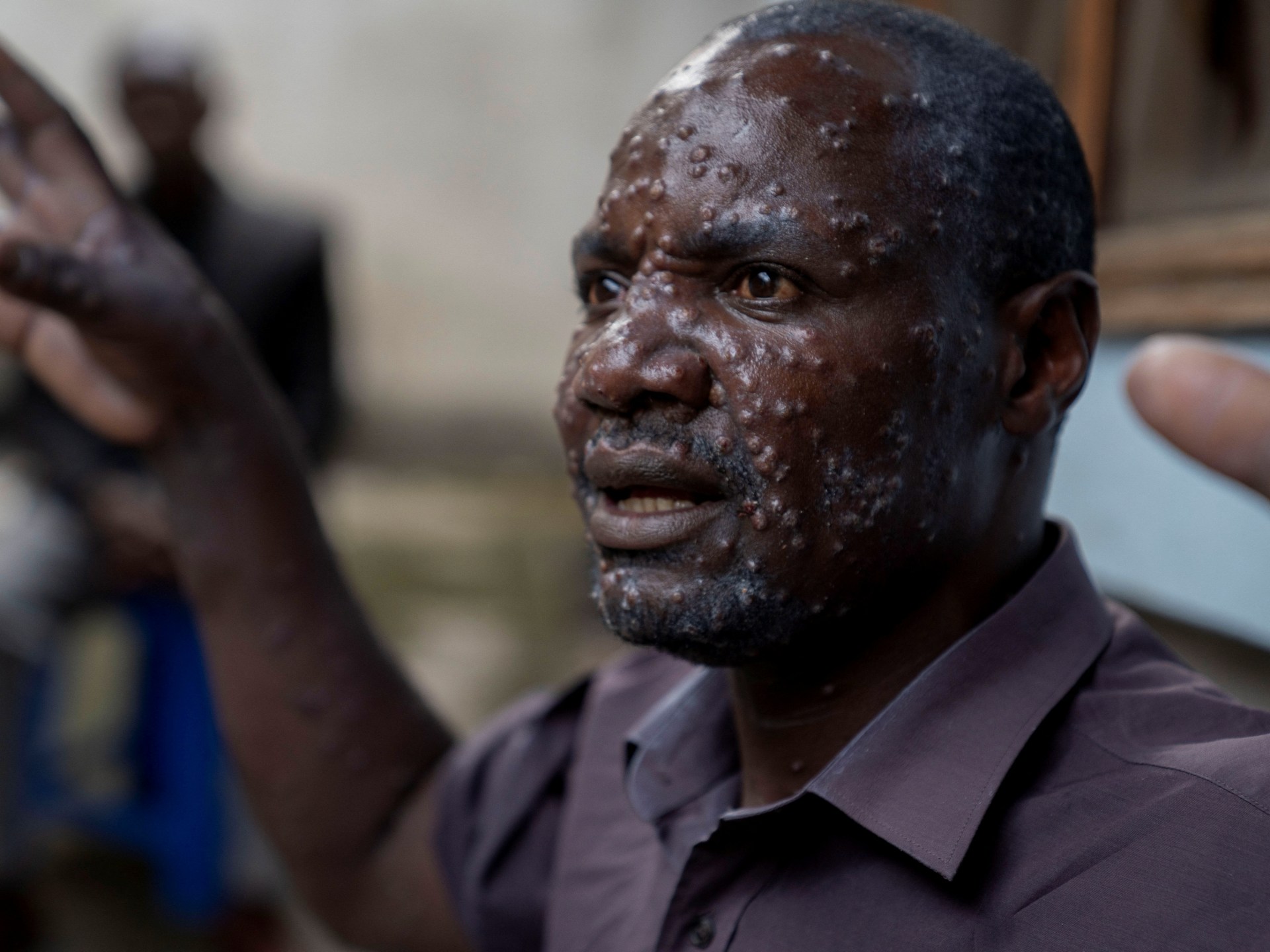 Africa CDC declares mpox a public health emergency | Health News