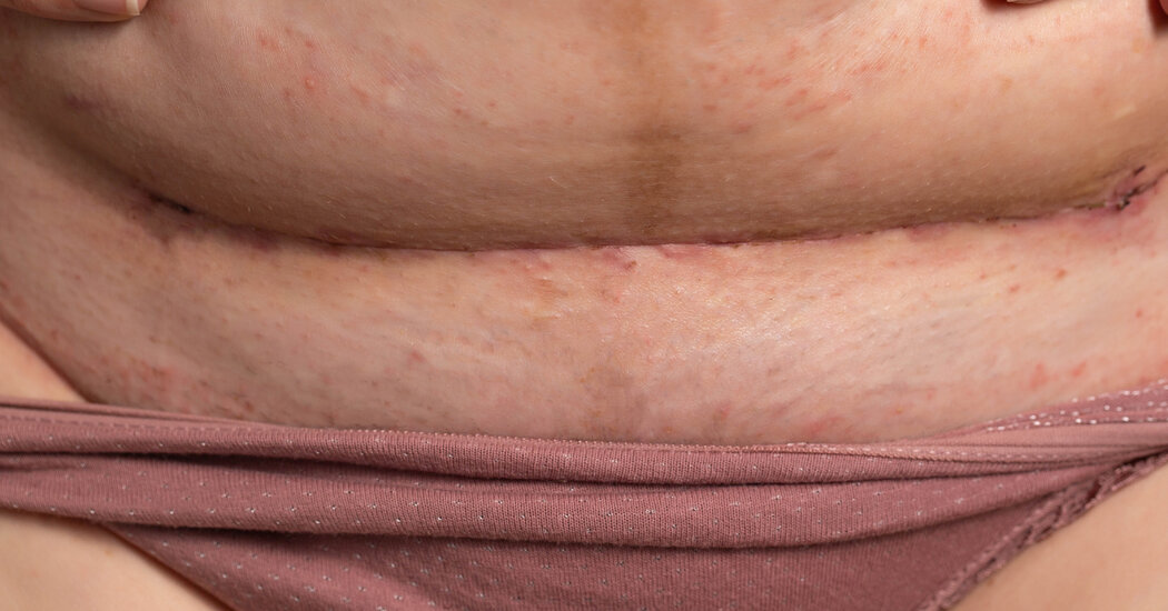 Why Is My C-Section Scar Painful, Itchy and Sometimes Smelly?