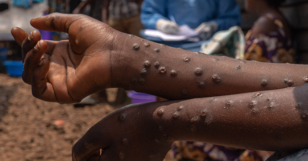 How Does Mpox Spread, and Who Is Most at Risk?