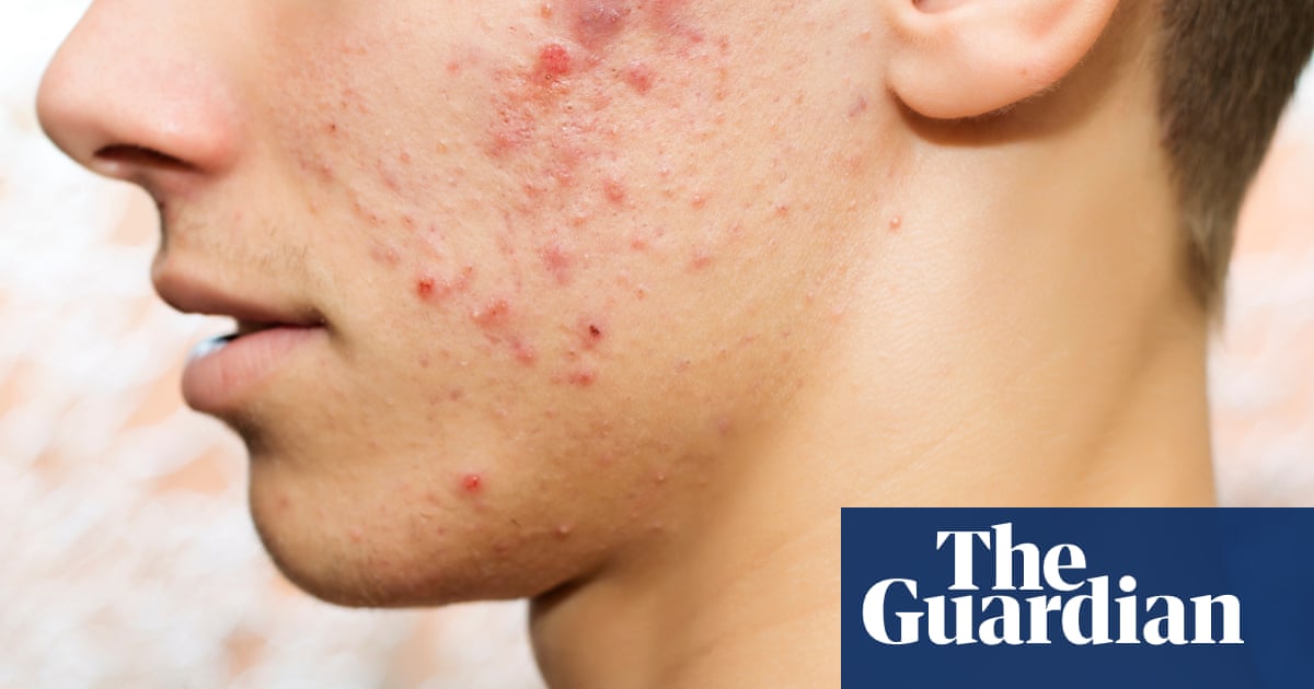 Acne rates in UK adolescents and young adults among highest in the world | Acne