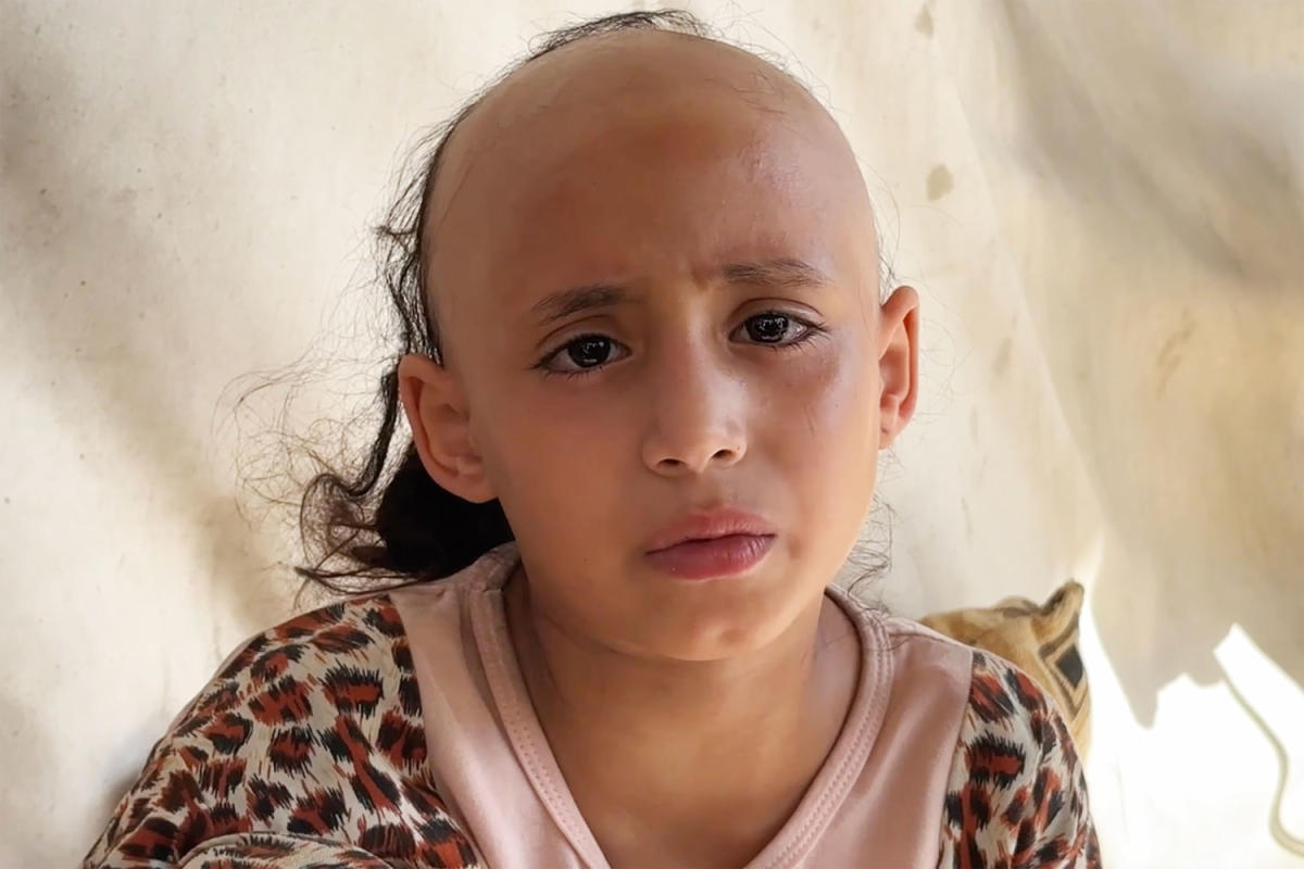 'Psychologically broken,' 8-year-old Sama loses her hair