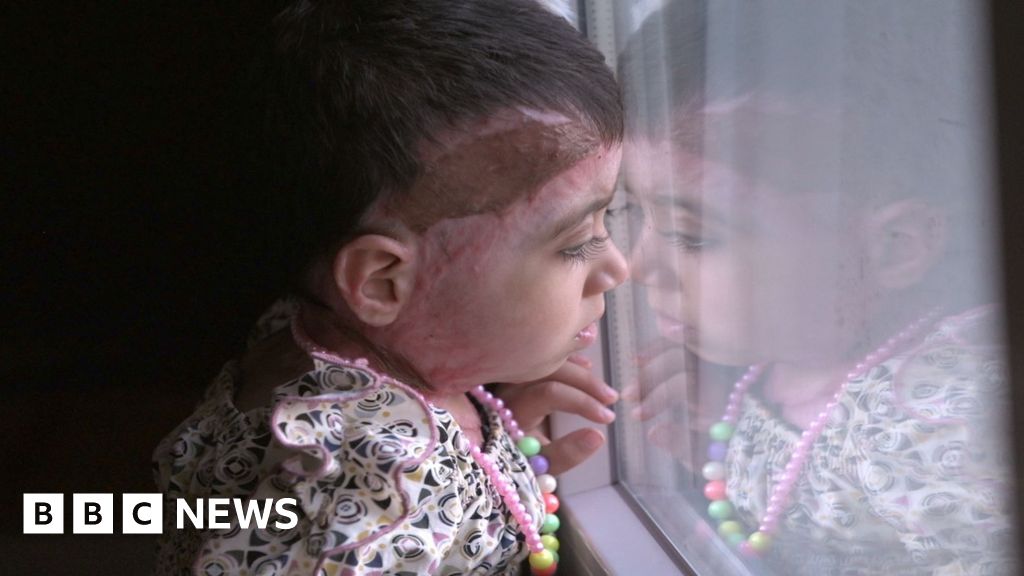 Injured Gaza girls make it to Italy for treatment after long wait