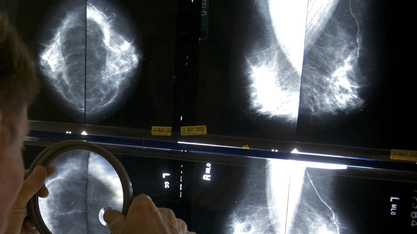 Mammograms will include information on dense breasts, per FDA rule : Shots