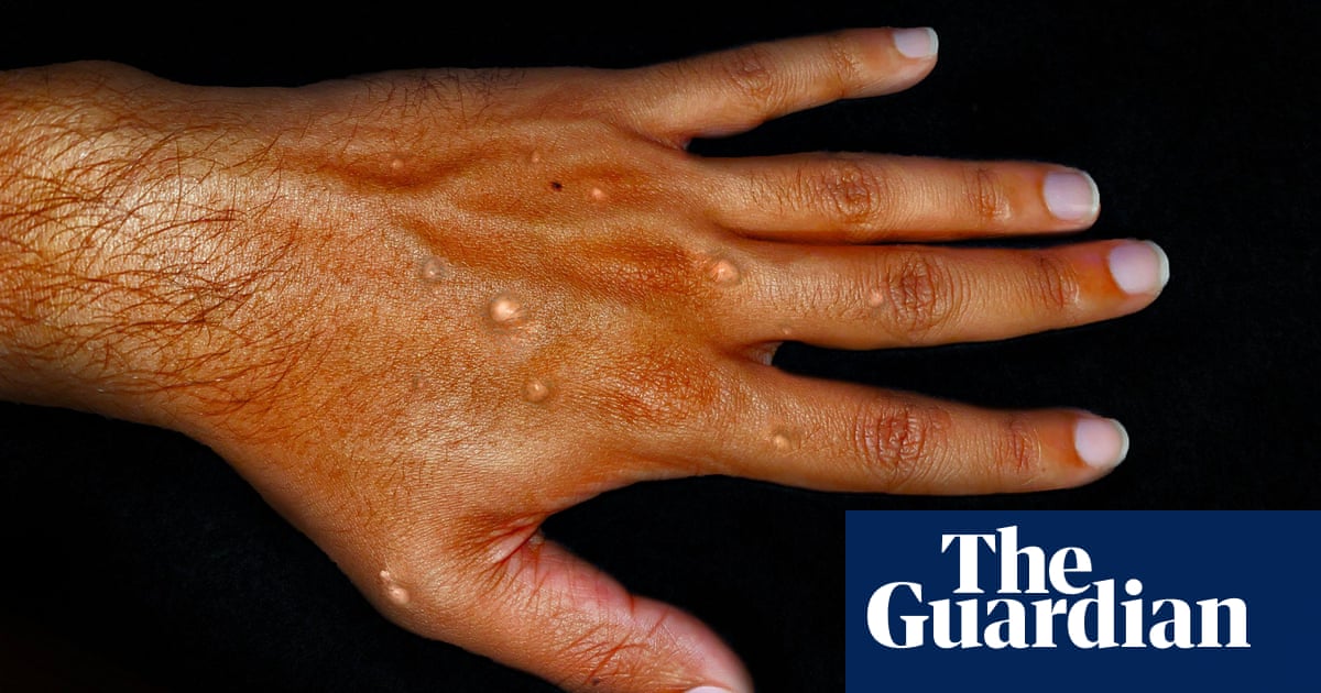 NSW records largest mpox outbreak and urges vaccination due to rising hospitalisations | Health