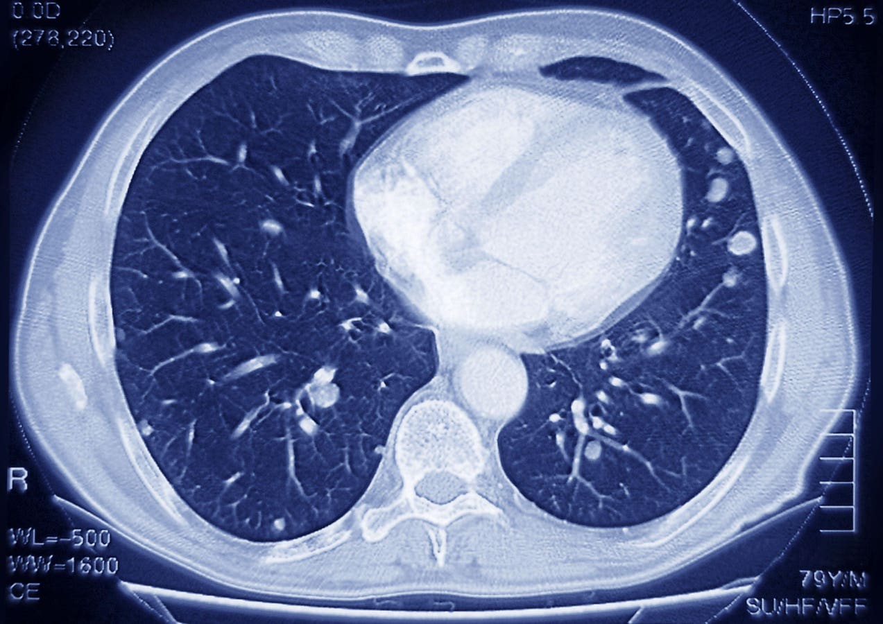 Less Than 1 In 5 Americans Who Are Eligible Are Getting Screen For Lung Cancer. Here’s Why