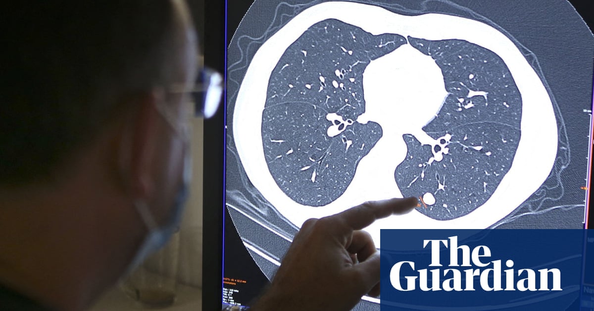 Study to look at why some people with aggressive cancer are ‘super-survivors’ | Cancer research